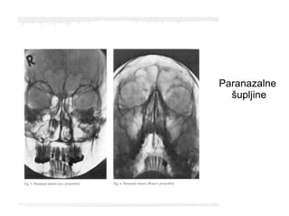Paranazalne
šupljine
 