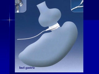 Inel gastric
 