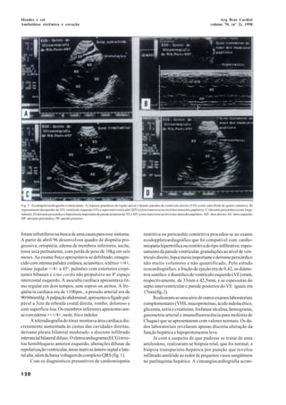 Mendes e col                                                                                                                                           Arq Bras Cardiol
Amiloidose sistêmica e coração                                                                                                                    volume 70, (nº 2), 1998




Fig. 2 - Ecodopplercardiografia evidenciando: A) aspecto granuloso da região apical e demais paredes do ventrículo direito (VD) (corte subxifóide de quatro câmaras); B)
espessamento das paredes do VD, ventrículo esquerdo (VE) e septo interventricular (SIV) (corte transverso ao nível dos músculos papilares); C) derrame pericárdico (corte longi-
tudinal); D) derrame pericárdico e hipocinesia importante da parede posterior do VE e SIV (corte transverso ao nível dos músculos papilares. AD- átrio direito; AE- átrio esquerdo;
DP- derrame pericárdico; PP- parede posterior.



foram infrutíferos na busca de uma causa para esse sintoma.                                   restritiva ou pericardite constritiva procedeu-se ao exame
A partir de abril/96 desenvolveu quadro de dispnéia pro-                                      ecodopplercardiográfico que foi compatível com cardio-
gressiva, ortopnéia, edema de membros inferiores, ascite,                                     miopatia hipertrófica ou restritiva do tipo infiltrativa: espes-
tosse seca permanente, com perda de peso de 10kg em seis                                      samento da parede ventricular, granulações ao nível de ven-
meses. Ao exame físico apresentava-se debilitado, emagre-                                     trículo direito, hipocinesia importante e derrame pericárdico
cido com intensa palidez cutânea, acianótico, ictérico +/4+,                                  não muito volumoso e não quantificado. Pelo estudo
estase jugular +/4+ a 45o, pulmões com estertores crepi-                                      ecocardiográfico, a fração de ejeção era de 0,42, os diâme-
tantes bibasais e ictus cordis não propulsivo no 4º espaço                                    tros sistólico e diastólico do ventrículo esquerdo (VE) eram,
intercostal esquerdo. À ausculta cardíaca apresentava rit-                                    respectivamente, de 33mm e 42,5mm, e as espessuras do
mo regular em dois tempos, sem sopros ou atritos. A fre-                                      septo interventricular e parede posterior do VE iguais em
qüência cardíaca era de 110bpm., a pressão arterial era de                                    17mm (fig. 2).
90/60mmHg. À palpação abdominal, apresentava fígado pal-                                            Realizaram-se uma série de outros exames laboratoriais
pável a 3cm da reborda costal direita, rombo, doloroso e                                      complementares (VHS, mucoproteínas, ácido indolacético,
com superfície lisa. Os membros inferiores apresentavam-                                      glicemia, uréia e creatinina, fosfatase alcalina, hemograma,
se com edema +++/4+, mole, frio e indolor.                                                    gasometria arterial e imunofluorescência para moléstia de
       A teleradiografia do tórax mostrava área cardíaca dis-                                 Chagas) que se apresentaram com valores normais. Os da-
cretamente aumentada às custas das cavidades direitas,                                        dos laboratoriais revelaram apenas discreta alteração da
derrame pleura bilateral moderado e discreto infiltrado                                       função hepática e hipoproteinemia leve.
intersticial bilateral difuso. O eletrocardiograma (ECG) reve-                                      Já com a suspeita de que pudesse se tratar de uma
lou hemibloqueio anterior esquerdo, alterações difusas da                                     amiloidose, realizaram-se biópsia retal, que foi normal, e
repolarização ventricular, áreas inativas ântero-septal e late-                               biópsia transparieto-hepática por punção que revelou
ral alta, além da baixa voltagem do complexo QRS (fig. 1).                                    infiltrado amilóide ao redor de pequenos vasos sangüíneos
       Com os diagnósticos presuntivos de cardiomiopatia                                      no parênquima hepático. A cineangiocardiografia acom-

120
 