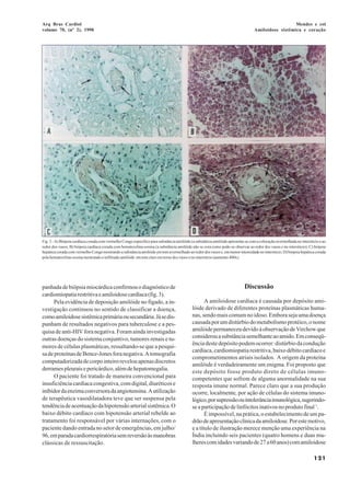 Arq Bras Cardiol                                                                                                                                    Mendes e col
volume 70, (nº 2), 1998                                                                                                           Amiloidose sistêmica e coração




Fig. 3 - A) Biópsia cardíaca corada com vermelho Congo específico para substância amilóide (a substância amilóide apresenta-se com a coloração avermelhada no interstício e ao
redor dos vasos; B) biópsia cardíaca corada com hematoxilina-eosina (a substância amilóide não se cora como pode-se observar ao redor dos vasos e no interstício); C) biópsia
hepática corada com vermelho Congo mostrando a substância amilóide em tom avermelhado ao redor dos vasos e, em menor intensidade no interstício; D) biópsia hepática corada
pela hematoxilina-eosina mostrando o infiltrado amilóide em tom claro em torno dos vasos e no interstício (aumento 400x).




panhada de biópsia miocárdica confirmou o diagnóstico de                                                                    Discussão
cardiomiopatia restritiva e amiloidose cardíaca (fig. 3).
      Pela evidência de deposição amilóide no fígado, a in-                                        A amiloidose cardíaca é causada por depósito ami-
vestigação continuou no sentido de classificar a doença,                                    lóide derivado de diferentes proteínas plasmáticas huma-
como amiloidose sistêmica primária ou secundária. Já se dis-                                nas, sendo mais comum no idoso. Embora seja uma doença
punham de resultados negativos para tuberculose e a pes-                                    causada por um distúrbio do metabolismo protéico, o nome
quisa de anti-HIV fora negativa. Foram ainda investigadas                                   amilóide permaneceu devido à observação de Virchow que
outras doenças do sistema conjuntivo, tumores renais e tu-                                  considerou a substância semelhante ao amido. Em conseqü-
                                                                                            ência deste depósito podem ocorrer: distúrbio da condução
mores de células plasmáticas, ressaltando-se que a pesqui-
                                                                                            cardíaca, cardiomiopatia restritiva, baixo débito cardíaco e
sa de proteínas de Bence-Jones fora negativa. A tomografia
                                                                                            comprometimentos atriais isolados. A origem da proteína
computadorizada de corpo inteiro revelou apenas discretos
                                                                                            amilóide é verdadeiramente um enigma. Foi proposto que
derrames pleurais e pericárdico, além de hepatomegalia.
                                                                                            este depósito fosse produto direto de células imuno-
      O paciente foi tratado de maneira convencional para                                   competentes que sofrem de alguma anormalidade na sua
insuficiência cardíaca congestiva, com digital, diuréticos e                                resposta imune normal. Parece claro que a sua produção
inibidor da enzima conversora da angiotensina. A utilização                                 ocorre, localmente, por ação de células do sistema imuno-
de terapêutica vasodilatadora teve que ser suspensa pela                                    lógico, por supressão ou intolerância imunológica, sugerindo-
tendência de acentuação da hipotensão arterial sistêmica. O                                 se a participação de linfócitos inativos no produto final 1.
baixo débito cardíaco com hipotensão arterial rebelde ao                                           É impossível, na prática, o estabelecimento de um pa-
tratamento foi responsável por várias internações, com o                                    drão de apresentação clínica da amiloidose. Por este motivo,
paciente dando entrada no setor de emergências, em julho/                                   e a título de ilustração merece menção uma experiência na
96, em parada cardiorrespiratória sem reversão às manobras                                  Índia incluindo seis pacientes (quatro homens e duas mu-
clássicas de ressuscitação.                                                                 lheres com idades variando de 27 a 60 anos) com amiloidose

                                                                                                                                                                      121
 
