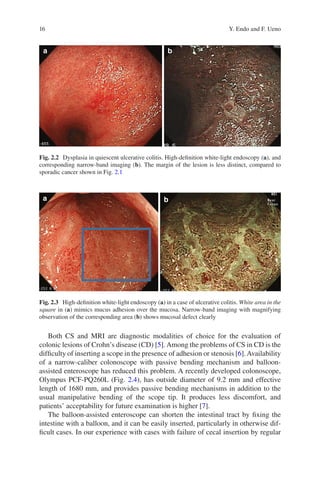 Advances In Endoscopy In Inflammatory Bowel Disease Toshiumi Hibi | PDF