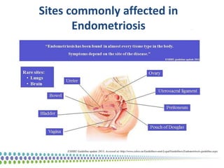 Sites commonly affected in
Endometriosis
ESHRE Guideline update 2013; Accessed at: http://www.eshre.eu/Guidelines-and-Lega...