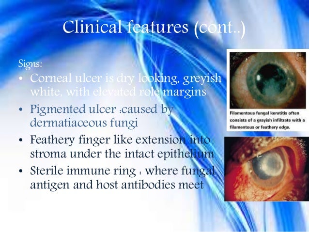 fungal corneal ulcer 3rd yr corneal ulcer