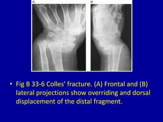 33 eponyms of fractures | PPTX