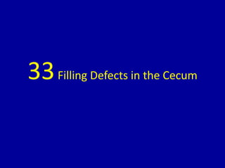 33Filling Defects in the Cecum
 