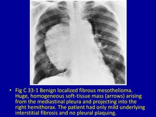 Spectacular Fibrous Mesothelioma Radiology Artwork Digital Art Spectacular Fibrous Mesothelioma Radiology Artwork Digital Art