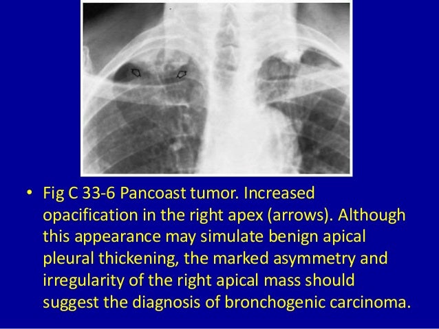 33 pleural based lesion