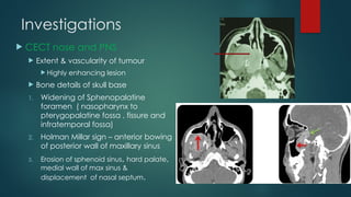 Comprehensive Overview of Nasopharyngeal Tumors: Angiofibroma and ...