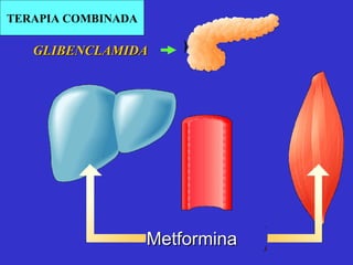 GLIBENCLAMIDA Metformina TERAPIA COMBINADA 