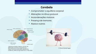 Lóbulos do cérebro. Jkwchui. (CC BY-3.0).
Wikimedia Commons. Disponível em:
https://commons.wikimedia.org/wiki/File:
Cerebrum_lobes-es.svg. Acesso em: 2 maio 2022.
© iStock/GettyImages
Cerebelo
• Comprometer o equilíbrio corporal
• Alterações no tônus postural
• Incoordenações motoras
• Presença de tremores
• Ataxia e outros
 