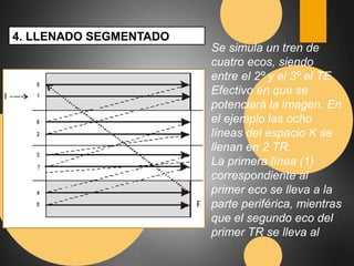 4. LLENADO SEGMENTADO 
Se simula un tren de 
cuatro ecos, siendo 
entre el 2º y el 3º el TE 
Efectivo en que se 
potenciará la imagen. En 
el ejemplo las ocho 
líneas del espacio K se 
llenan en 2 TR. 
La primera línea (1) 
correspondiente al 
primer eco se lleva a la 
parte periférica, mientras 
que el segundo eco del 
primer TR se lleva al 
 