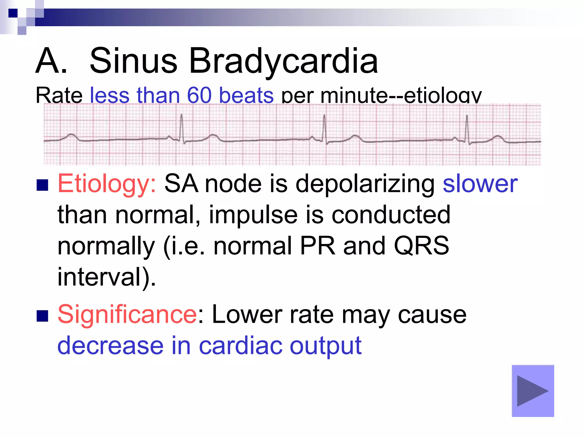 A. Sinus Bradycardia
Rate less than 60 beats per minute--etiology
 Etiology: SA node is depolarizing slower
than normal, impulse is conducted
normally (i.e. normal PR and QRS
interval).
 Significance: Lower rate may cause
decrease in cardiac output
 
