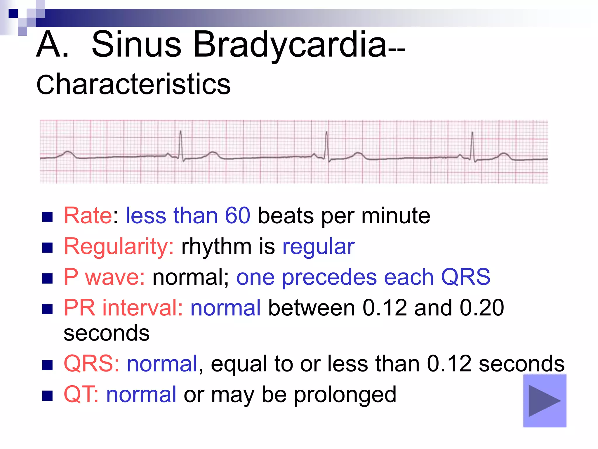 A. Sinus Bradycardia--
Characteristics
 Rate: less than 60 beats per minute
 Regularity: rhythm is regular
 P wave: normal; one precedes each QRS
 PR interval: normal between 0.12 and 0.20
seconds
 QRS: normal, equal to or less than 0.12 seconds
 QT: normal or may be prolonged
 