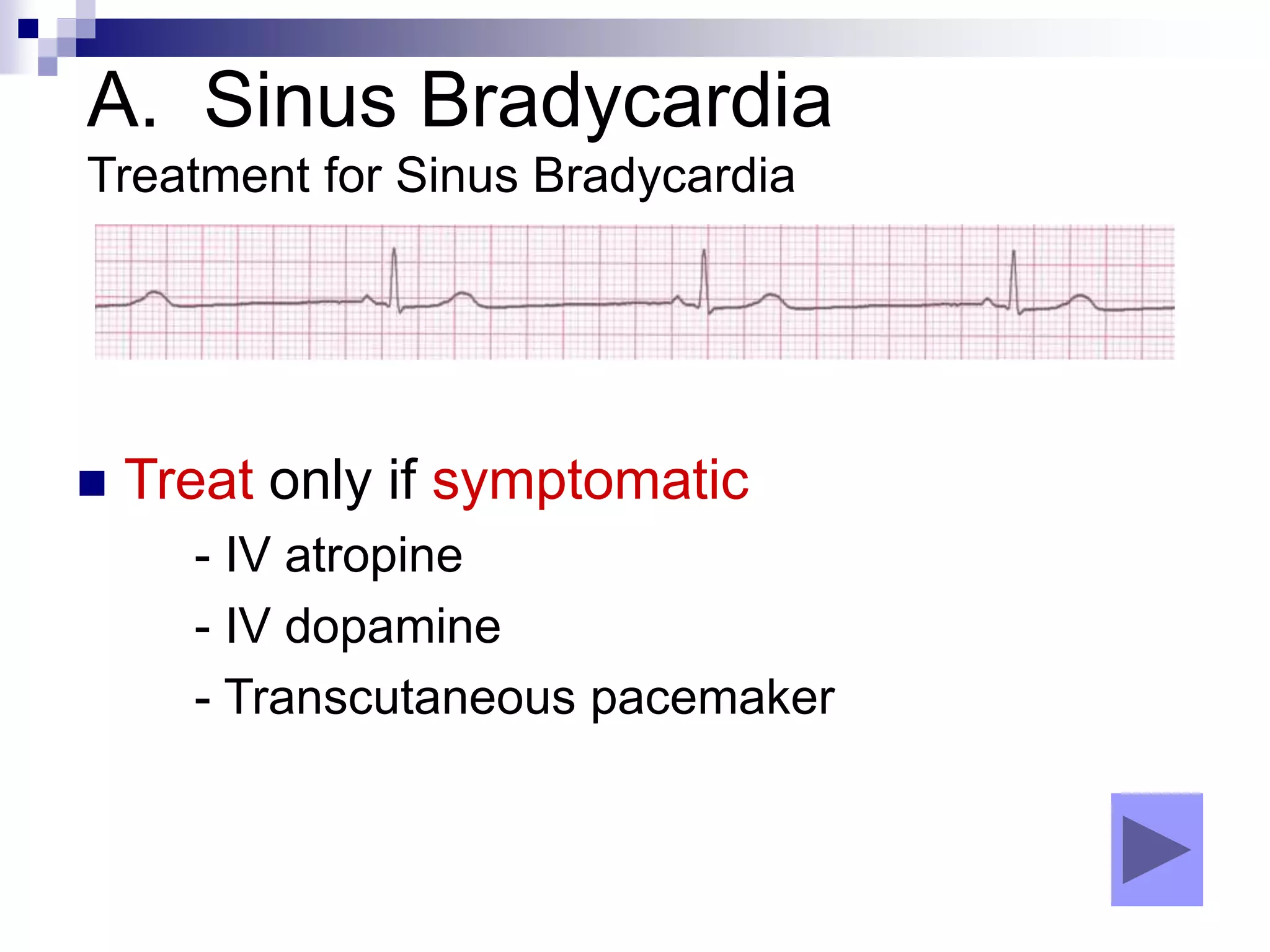 A. Sinus Bradycardia
Treatment for Sinus Bradycardia
 Treat only if symptomatic
- IV atropine
- IV dopamine
- Transcutaneous pacemaker
 