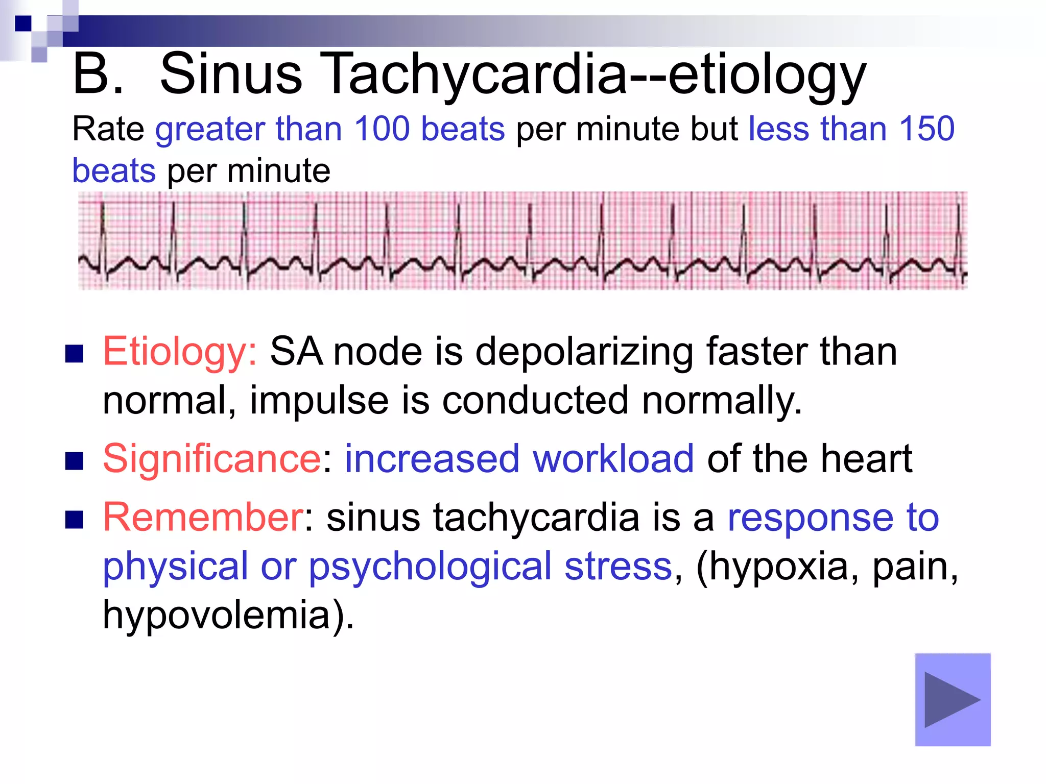 B. Sinus Tachycardia--etiology
Rate greater than 100 beats per minute but less than 150
beats per minute
 Etiology: SA node is depolarizing faster than
normal, impulse is conducted normally.
 Significance: increased workload of the heart
 Remember: sinus tachycardia is a response to
physical or psychological stress, (hypoxia, pain,
hypovolemia).
 