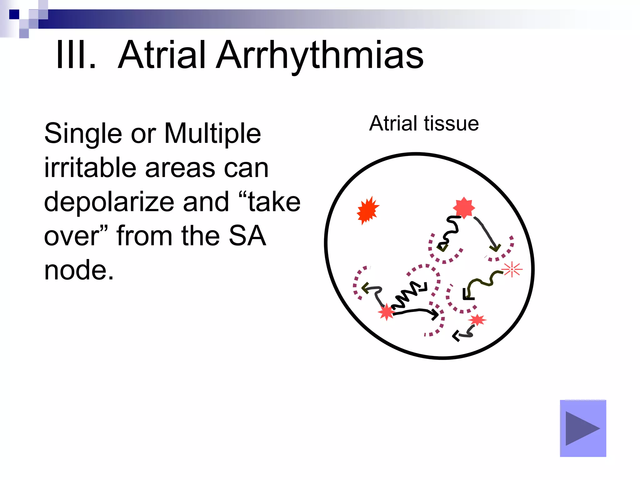 III. Atrial Arrhythmias
Single or Multiple
irritable areas can
depolarize and “take
over” from the SA
node.
Atrial tissue
 