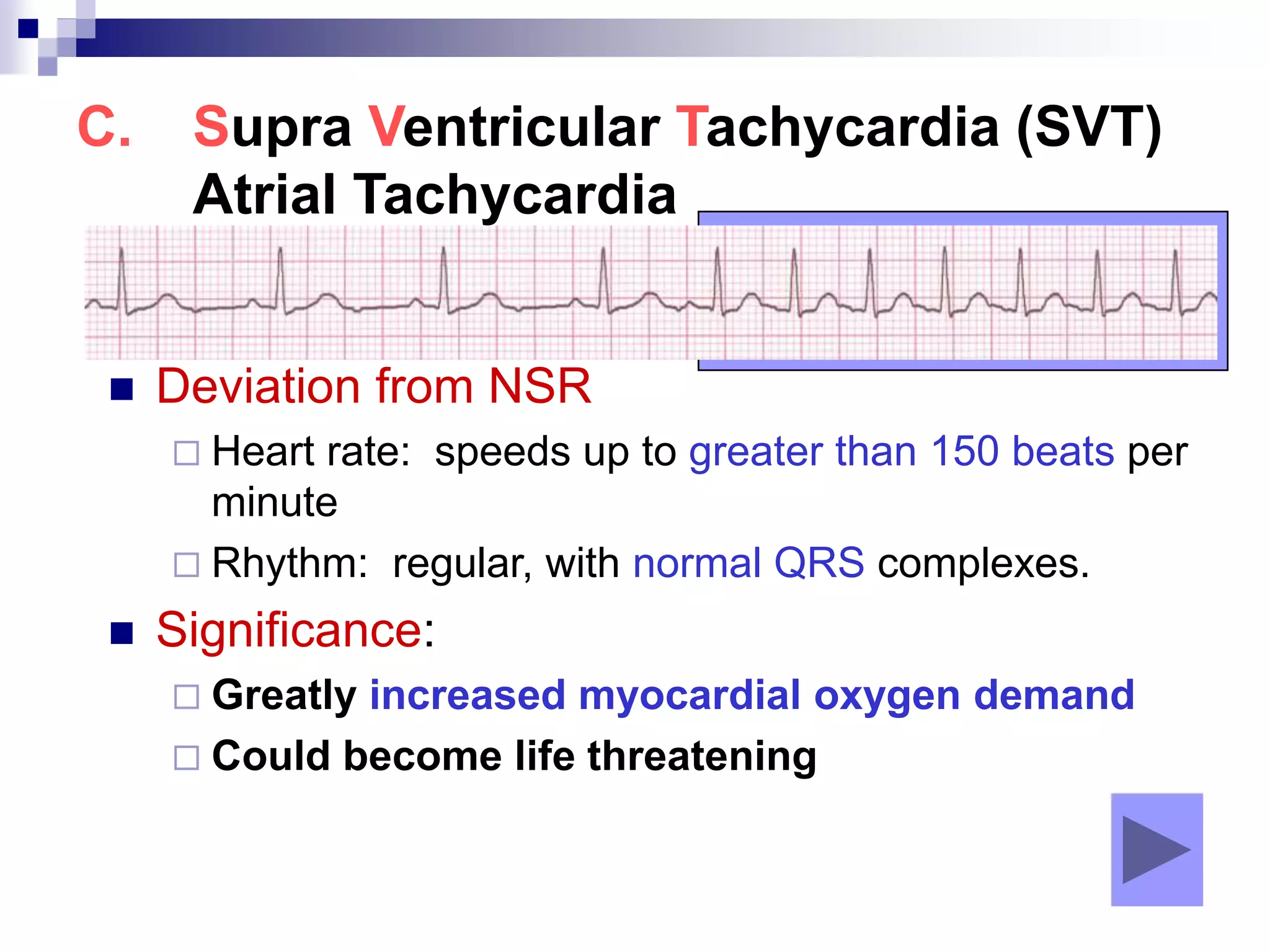 C. Supra Ventricular Tachycardia (SVT)
Atrial Tachycardia
 Deviation from NSR
 Heart rate: speeds up to greater than 150 beats per
minute
 Rhythm: regular, with normal QRS complexes.
 Significance:
 Greatly increased myocardial oxygen demand
 Could become life threatening
 