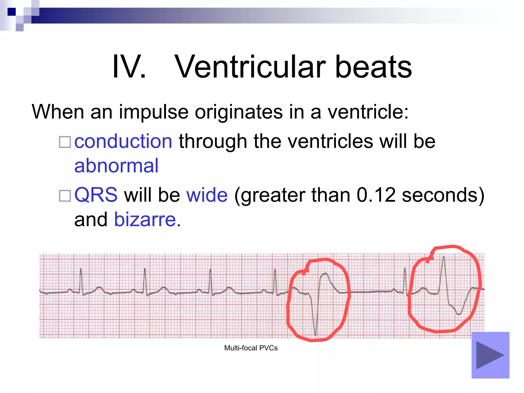IV. Ventricular beats
When an impulse originates in a ventricle:
conduction through the ventricles will be
abnormal
QRS will be wide (greater than 0.12 seconds)
and bizarre.
Multi-focal PVCs
 