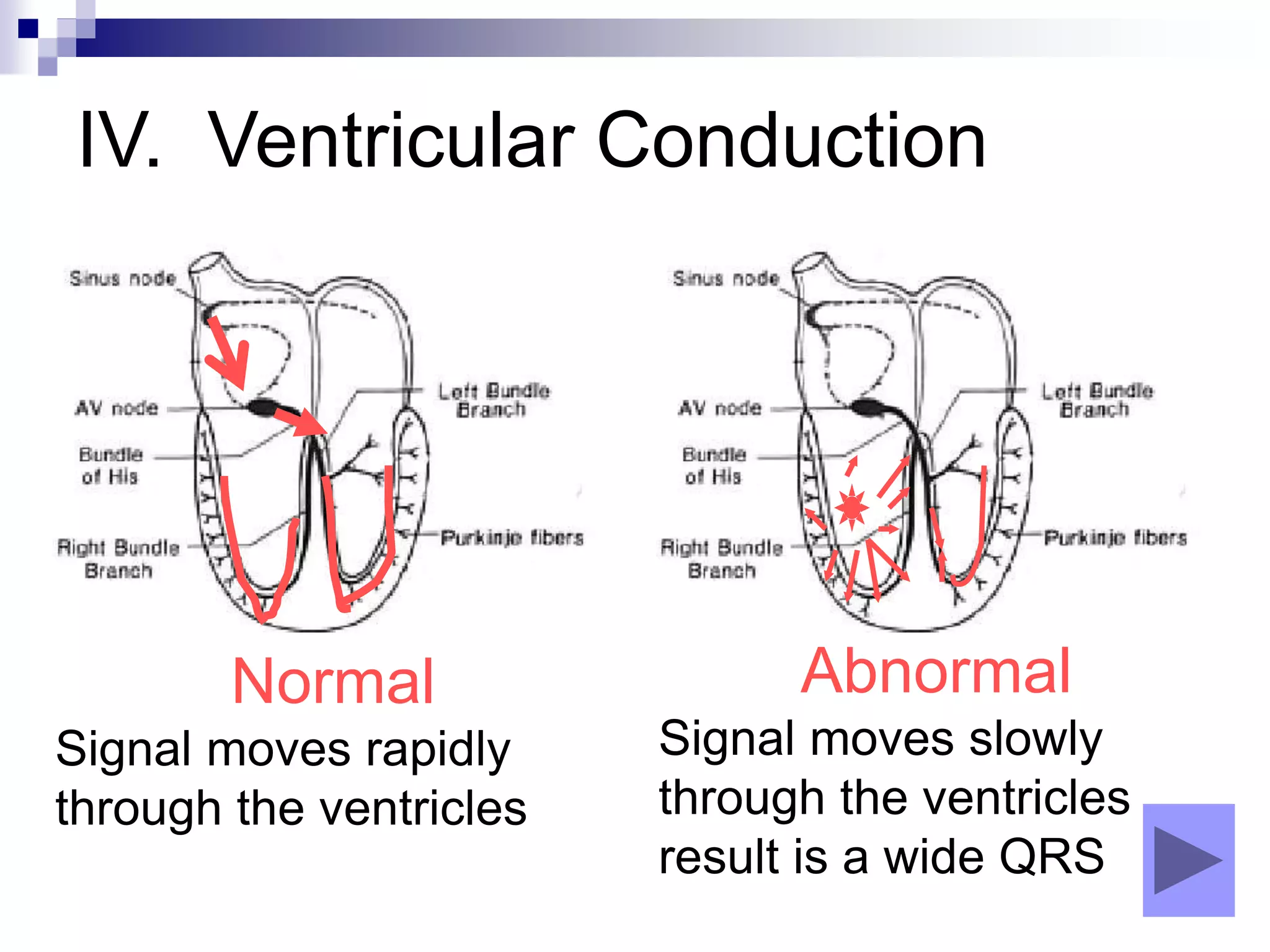 IV. Ventricular Conduction
Normal
Signal moves rapidly
through the ventricles
Abnormal
Signal moves slowly
through the ventricles
result is a wide QRS
 