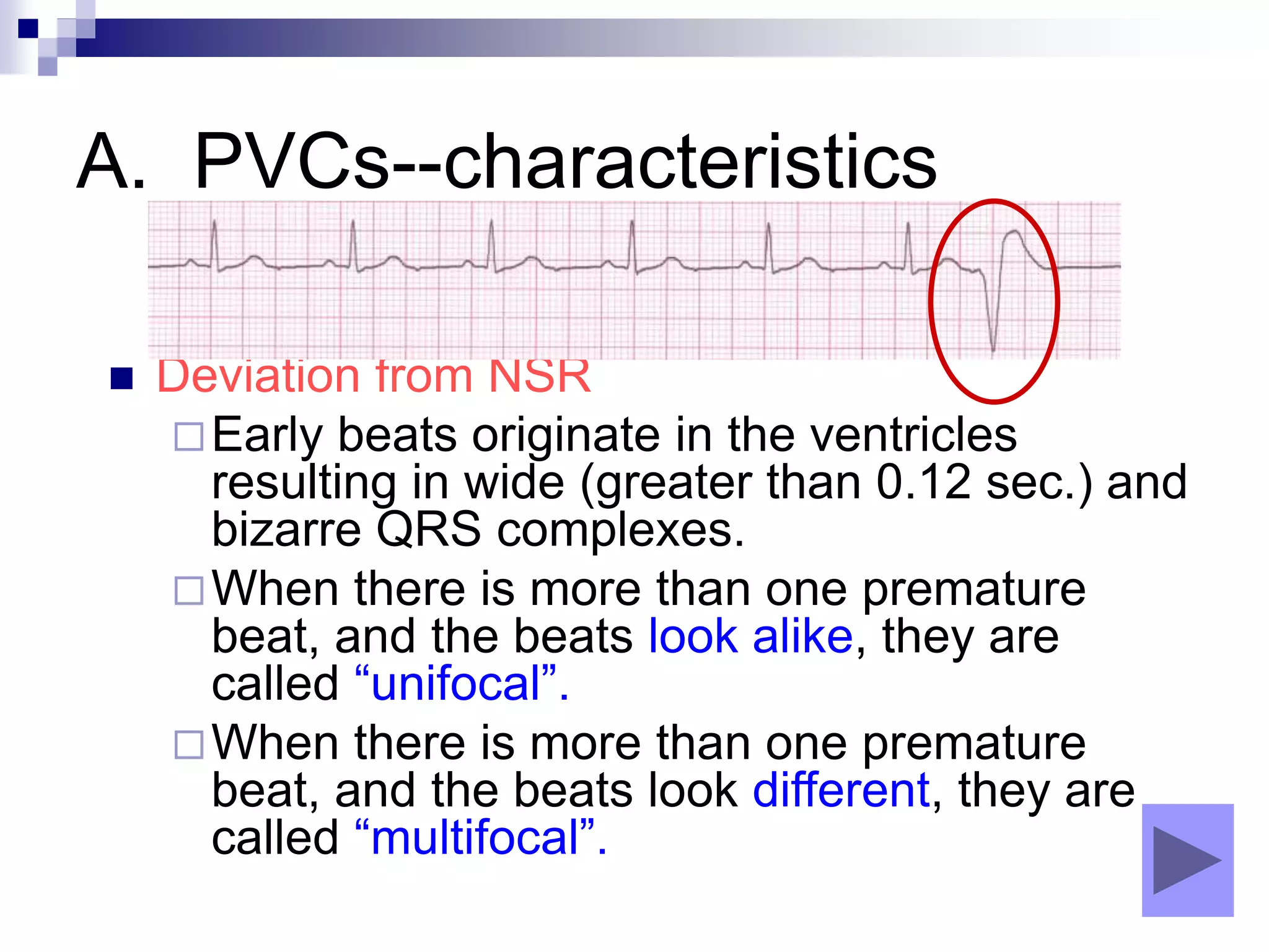 A. PVCs--characteristics
 Deviation from NSR
Early beats originate in the ventricles
resulting in wide (greater than 0.12 sec.) and
bizarre QRS complexes.
When there is more than one premature
beat, and the beats look alike, they are
called “unifocal”.
When there is more than one premature
beat, and the beats look different, they are
called “multifocal”.
 