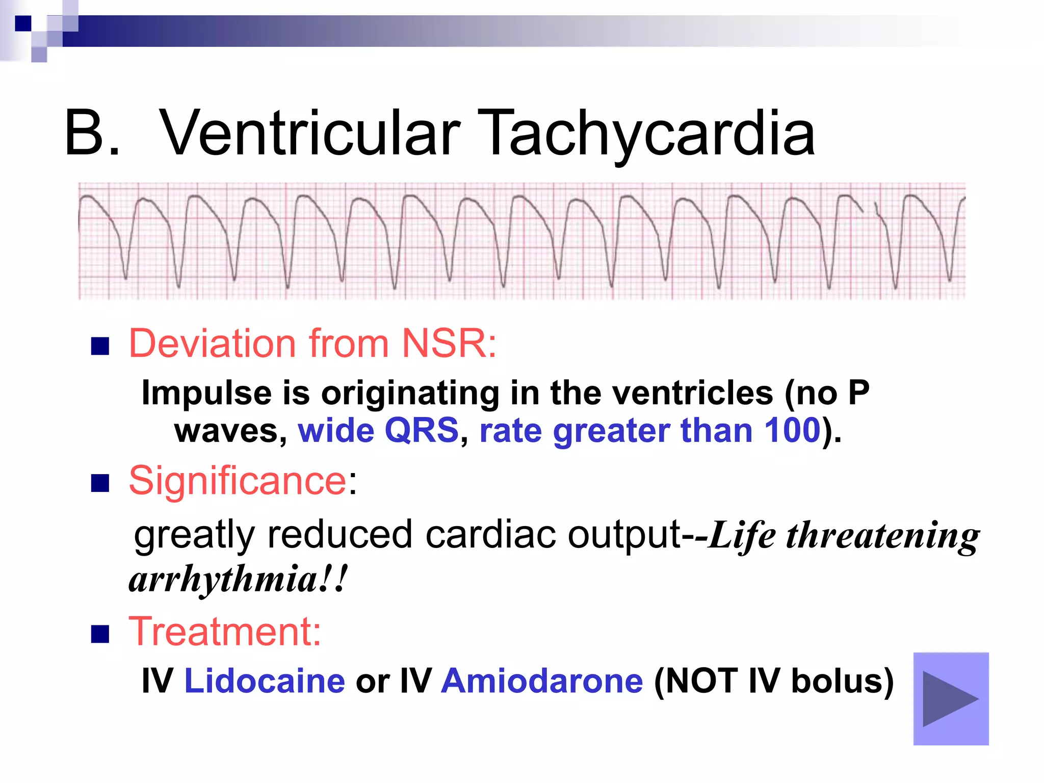 B. Ventricular Tachycardia
 Deviation from NSR:
Impulse is originating in the ventricles (no P
waves, wide QRS, rate greater than 100).
 Significance:
greatly reduced cardiac output--Life threatening
arrhythmia!!
 Treatment:
IV Lidocaine or IV Amiodarone (NOT IV bolus)
 