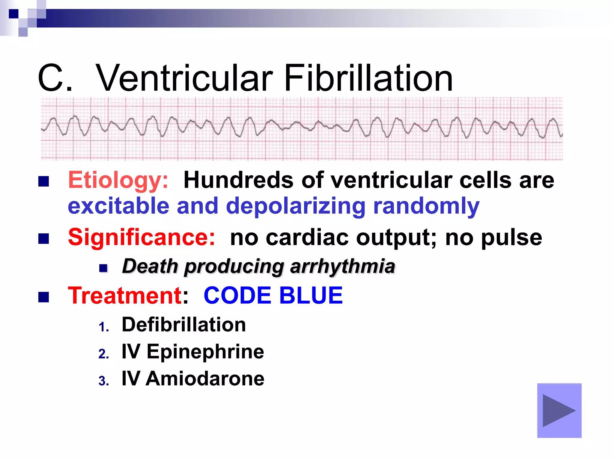 C. Ventricular Fibrillation
 Etiology: Hundreds of ventricular cells are
excitable and depolarizing randomly
 Significance: no cardiac output; no pulse
 Death producing arrhythmia
 Treatment: CODE BLUE
1. Defibrillation
2. IV Epinephrine
3. IV Amiodarone
 