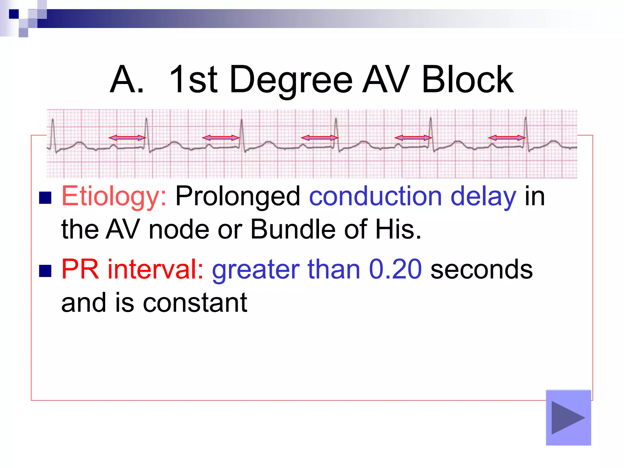 A. 1st Degree AV Block
 Etiology: Prolonged conduction delay in
the AV node or Bundle of His.
 PR interval: greater than 0.20 seconds
and is constant
 