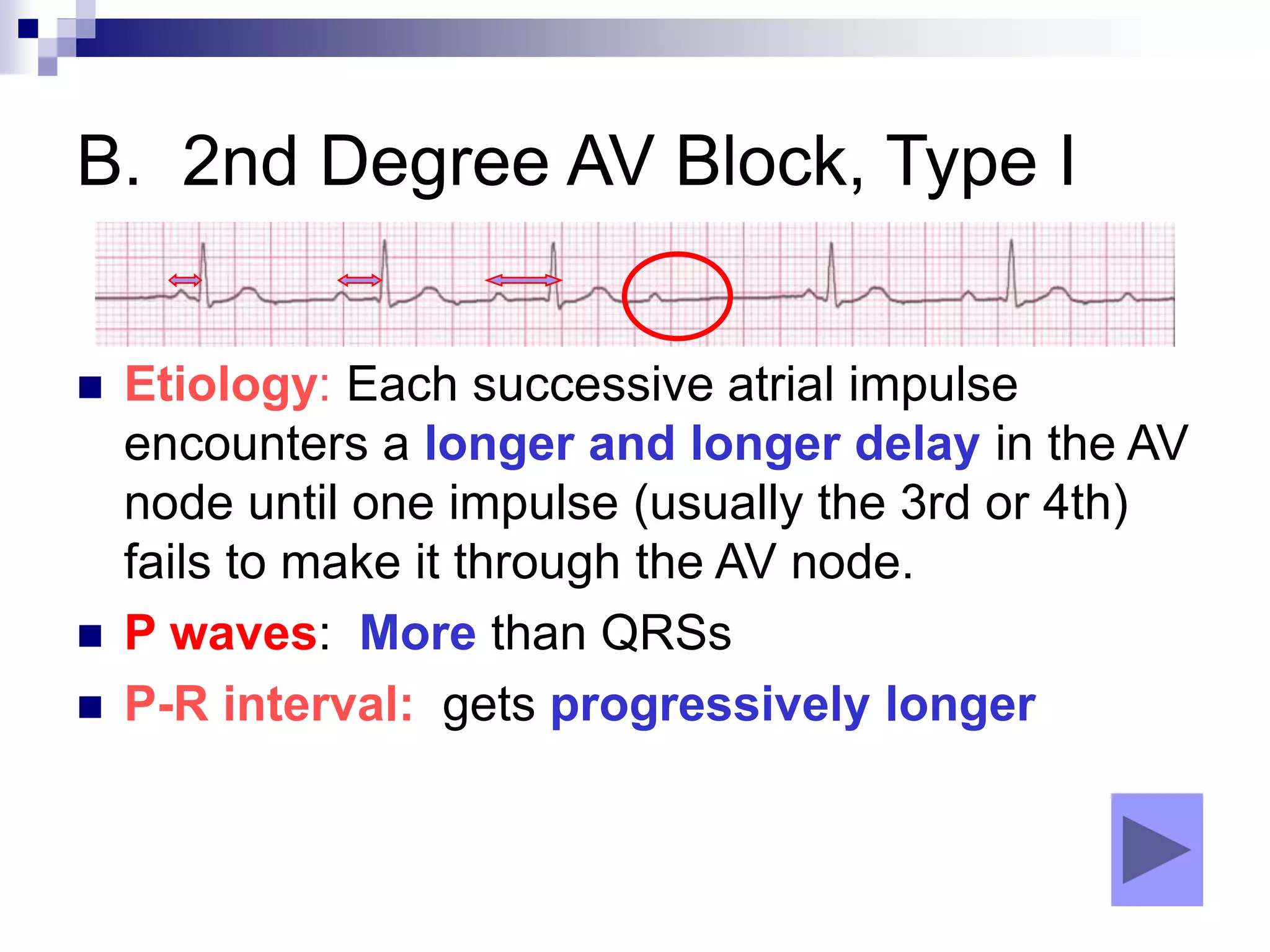B. 2nd Degree AV Block, Type I
 Etiology: Each successive atrial impulse
encounters a longer and longer delay in the AV
node until one impulse (usually the 3rd or 4th)
fails to make it through the AV node.
 P waves: More than QRSs
 P-R interval: gets progressively longer
 