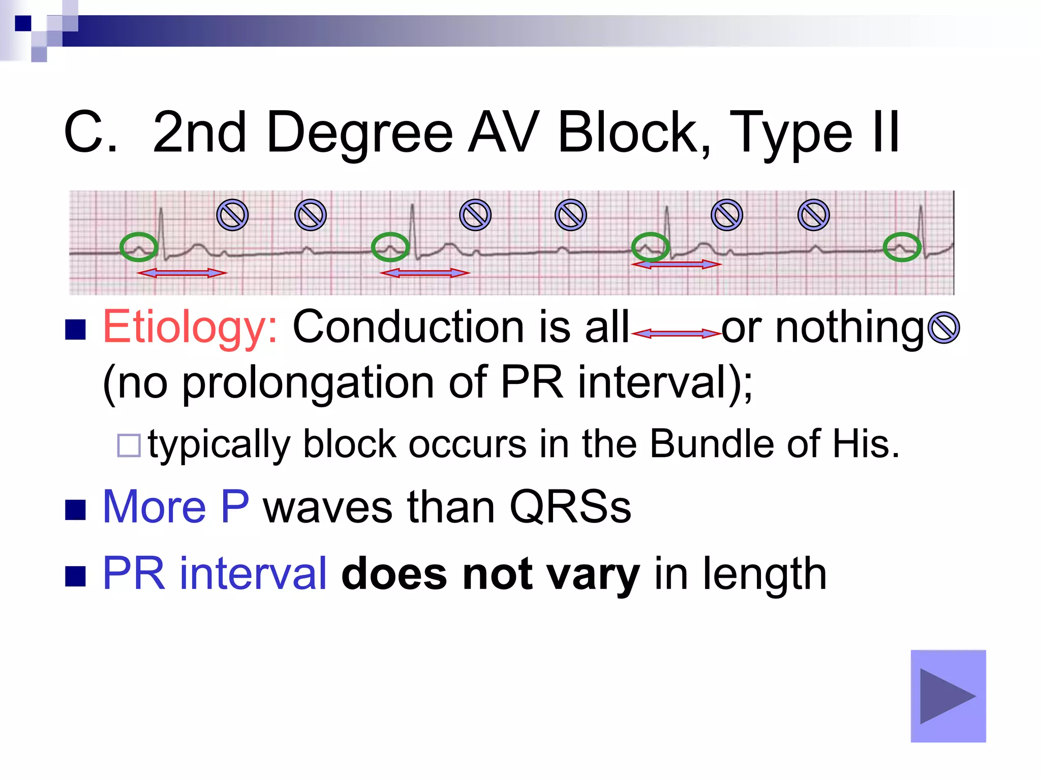 C. 2nd Degree AV Block, Type II
 Etiology: Conduction is all or nothing
(no prolongation of PR interval);
typically block occurs in the Bundle of His.
 More P waves than QRSs
 PR interval does not vary in length
 