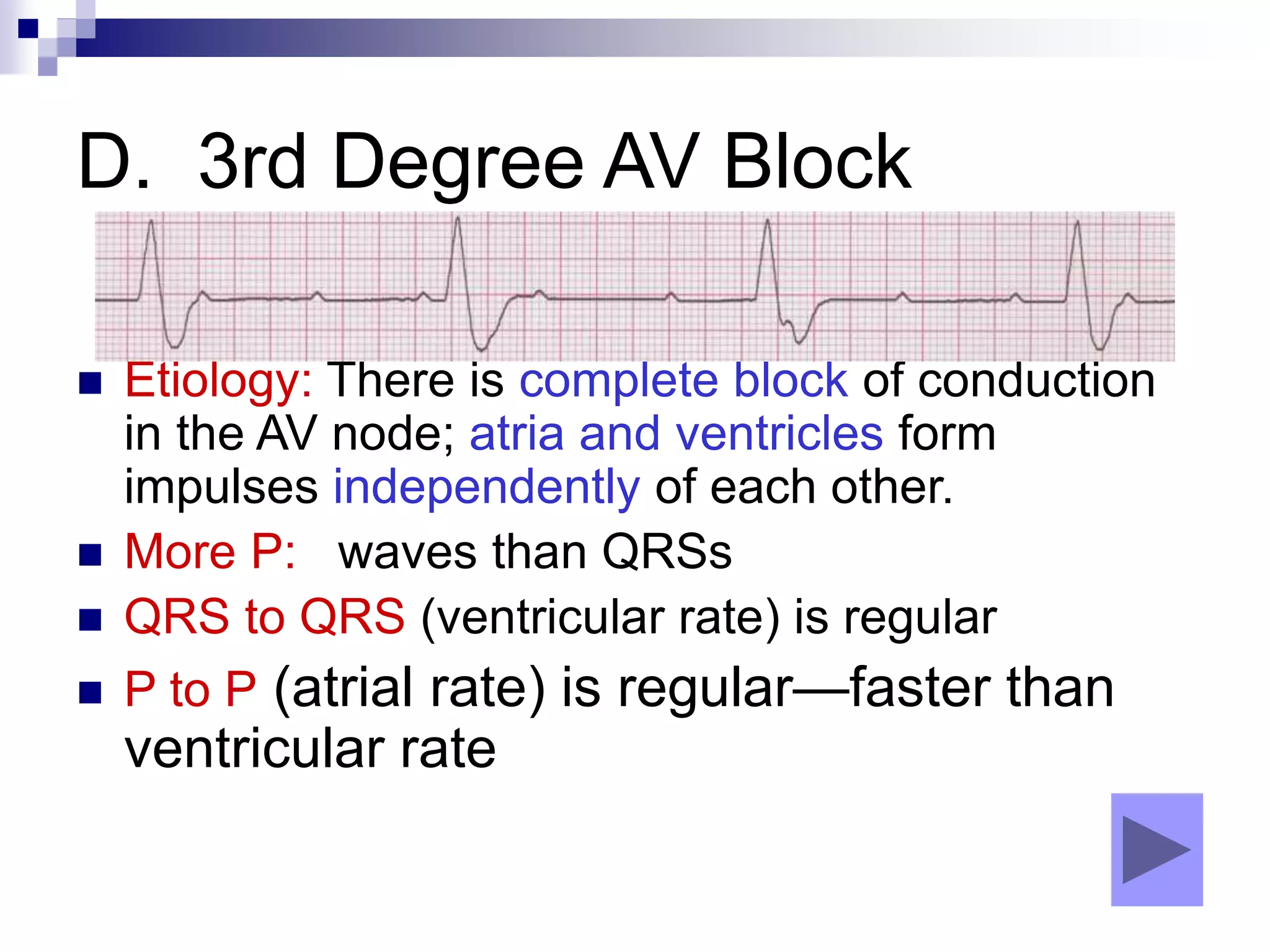 D. 3rd Degree AV Block
 Etiology: There is complete block of conduction
in the AV node; atria and ventricles form
impulses independently of each other.
 More P: waves than QRSs
 QRS to QRS (ventricular rate) is regular
 P to P (atrial rate) is regular—faster than
ventricular rate
 