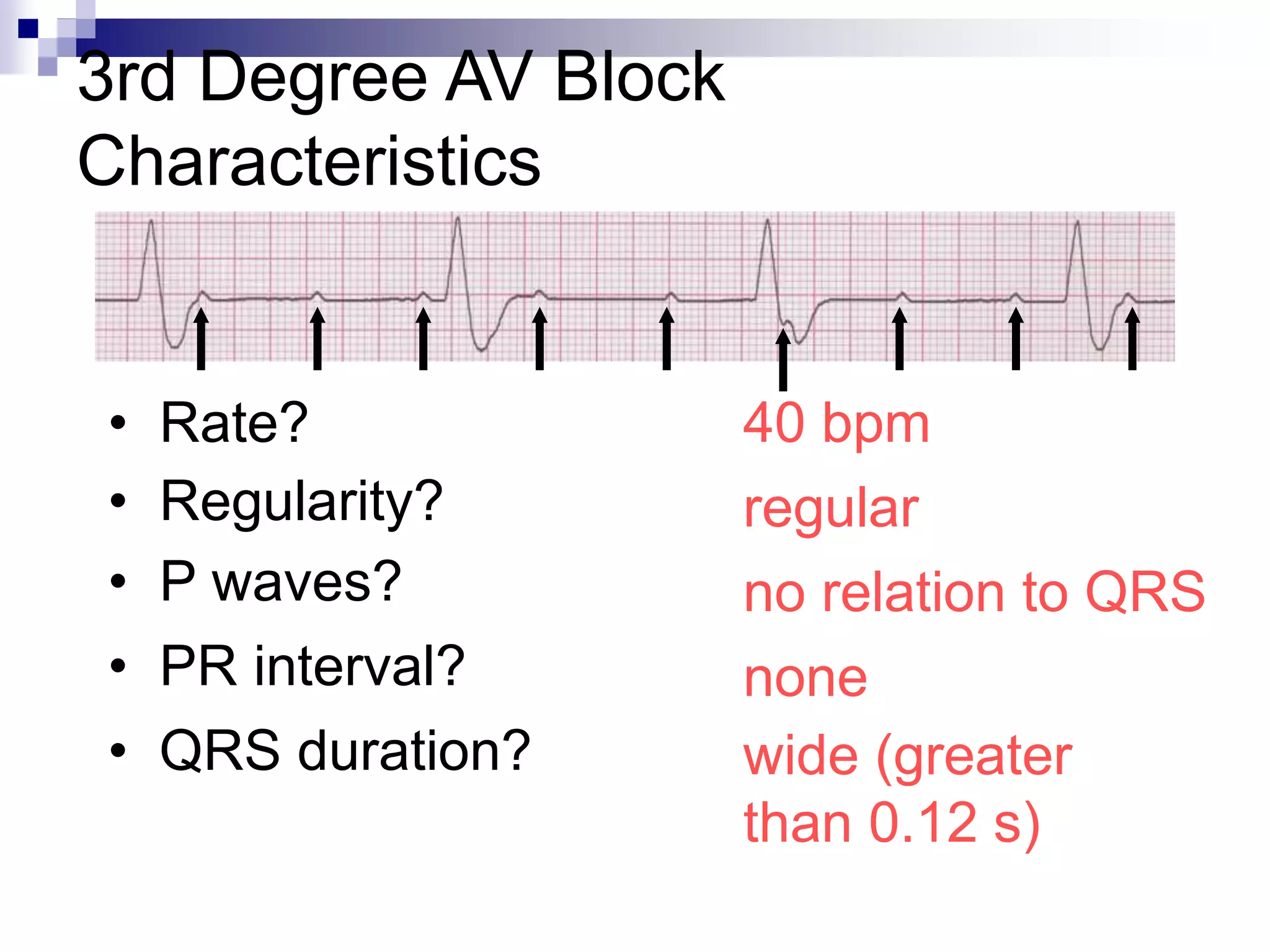 3rd Degree AV Block
Characteristics
40 bpm
• Rate?
• Regularity? regular
no relation to QRS
wide (greater
than 0.12 s)
• P waves?
• PR interval? none
• QRS duration?
 