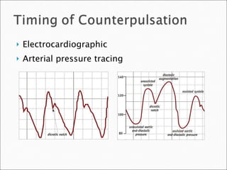 Electrocardiographic Arterial pressure tracing 