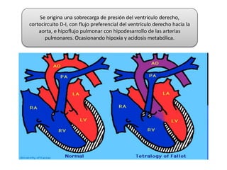 Se origina una sobrecarga de presión del ventrículo derecho,
cortocircuito D-I, con flujo preferencial del ventrículo derecho hacia la
aorta, e hipoflujo pulmonar con hipodesarrollo de las arterias
pulmonares. Ocasionando hipoxia y acidosis metabólica.
 