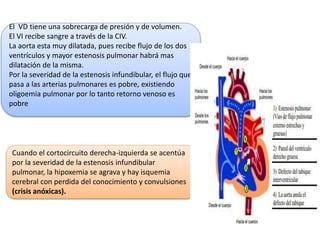 El VD tiene una sobrecarga de presión y de volumen.
El VI recibe sangre a través de la CIV.
La aorta esta muy dilatada, pues recibe flujo de los dos
ventrículos y mayor estenosis pulmonar habrá mas
dilatación de la misma.
Por la severidad de la estenosis infundibular, el flujo que
pasa a las arterias pulmonares es pobre, existiendo
oligoemia pulmonar por lo tanto retorno venoso es
pobre
Cuando el cortocircuito derecha-izquierda se acentúa
por la severidad de la estenosis infundibular
pulmonar, la hipoxemia se agrava y hay isquemia
cerebral con perdida del conocimiento y convulsiones
(crisis anóxicas).
 