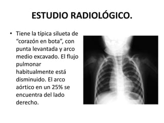 ESTUDIO RADIOLÓGICO.
• Tiene la típica silueta de
“corazón en bota”, con
punta levantada y arco
medio excavado. El flujo
pulmonar
habitualmente está
disminuido. El arco
aórtico en un 25% se
encuentra del lado
derecho.
 