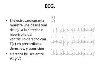 ECG.
• El electrocardiograma
muestra una desviación
del eje a la derecha e
hipertrofia del
ventrículo derecho con
T(+) en precordiales
derechas, y transición
• eléctrica brusca entre
V1 y V2.
 