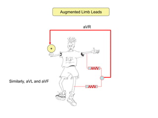 Augmented Limb Leads
+
aVR
Similarly, aVL and aVF
 