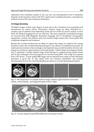 Signal and Image Denoising Using Wavelet Transform 509
important if the oscillation number is not very low, the decomposition level is absolutely
depends on the frequency band of the PCG signal and its sampling frequency, and rigresure
method is best of the noise estimation techniques.
5.3 Image denoising
All digital images contain some degree of noise due to the corruption in its acquisition and
transmission by various effects. Particularly, medical image are likely disturbed by a
complex type of addition noise depending on the devices which are used to capture or store
them. No medical imaging devices are noise free. The most commonly used medical images
are received from MRI (Magnetic Resonance Imaging) and CT (Computed Tomography)
equipments. Usually, the addition noise into medical image reduces the visual quality that
complicates diagnosis and treatment.
Because the wavelet transform has an ability to capture the energy of a signal in few energy
transform values, the wavelet denoising technique is very effective as stated previous parts. As
stated previous sections, when an image is decomposed using wavelet transform, the four sub-
images are produced, approximation, horizontal details, vertical details and diagonal details.
Fig. 11 represents a sample medical image which belongs to a patient having cranial trauma
and its four subimages when decomposed for one level using DWT. This image has acquired
from a BT device. A noise added MRI image and its denoised form using wavelet denoising
procedure is given Fig. 12. The added noise has Gaussian distribution, and symlet6,
decomposition level of two, hard thresholding are chosen as wavelet denoising parameters.
Fig. 11. Decomposition of a sample medical image; original, approximation, horizontal
details, vertical details, and diagonal details in left to right.
Fig. 12. A noisy image having PSNR 62dB and its denoised version.
www.intechopen.com
 