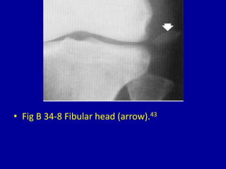 • Fig B 34-8 Fibular head (arrow).43