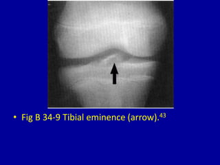• Fig B 34-9 Tibial eminence (arrow).43