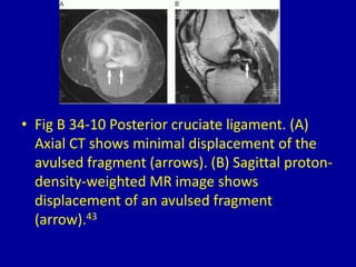 • Fig B 34-10 Posterior cruciate ligament. (A)
Axial CT shows minimal displacement of the
avulsed fragment (arrows). (B) Sagittal proton-
density-weighted MR image shows
displacement of an avulsed fragment
(arrow).43
