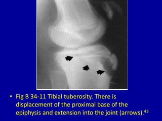 • Fig B 34-11 Tibial tuberosity. There is
displacement of the proximal base of the
epiphysis and extension into the joint (arrows).43