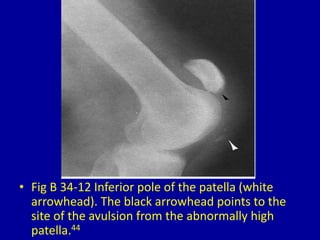 • Fig B 34-12 Inferior pole of the patella (white
arrowhead). The black arrowhead points to the
site of the avulsion from the abnormally high
patella.44