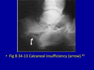 • Fig B 34-13 Calcaneal insufficiency (arrow).43