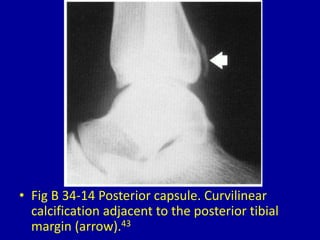 • Fig B 34-14 Posterior capsule. Curvilinear
calcification adjacent to the posterior tibial
margin (arrow).43