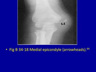 • Fig B 34-18 Medial epicondyle (arrowheads).44