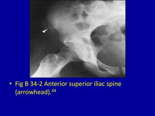 • Fig B 34-2 Anterior superior iliac spine
(arrowhead).44