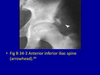 • Fig B 34-3 Anterior inferior iliac spine
(arrowhead).44