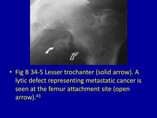 • Fig B 34-5 Lesser trochanter (solid arrow). A
lytic defect representing metastatic cancer is
seen at the femur attachment site (open
arrow).43