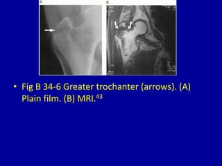 • Fig B 34-6 Greater trochanter (arrows). (A)
Plain film. (B) MRI.43